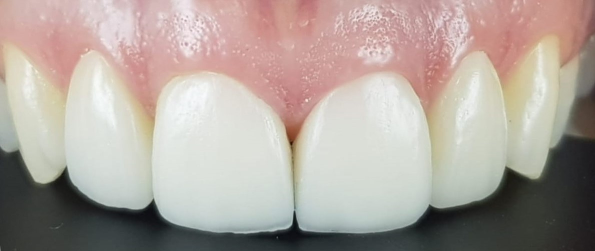 After treatment