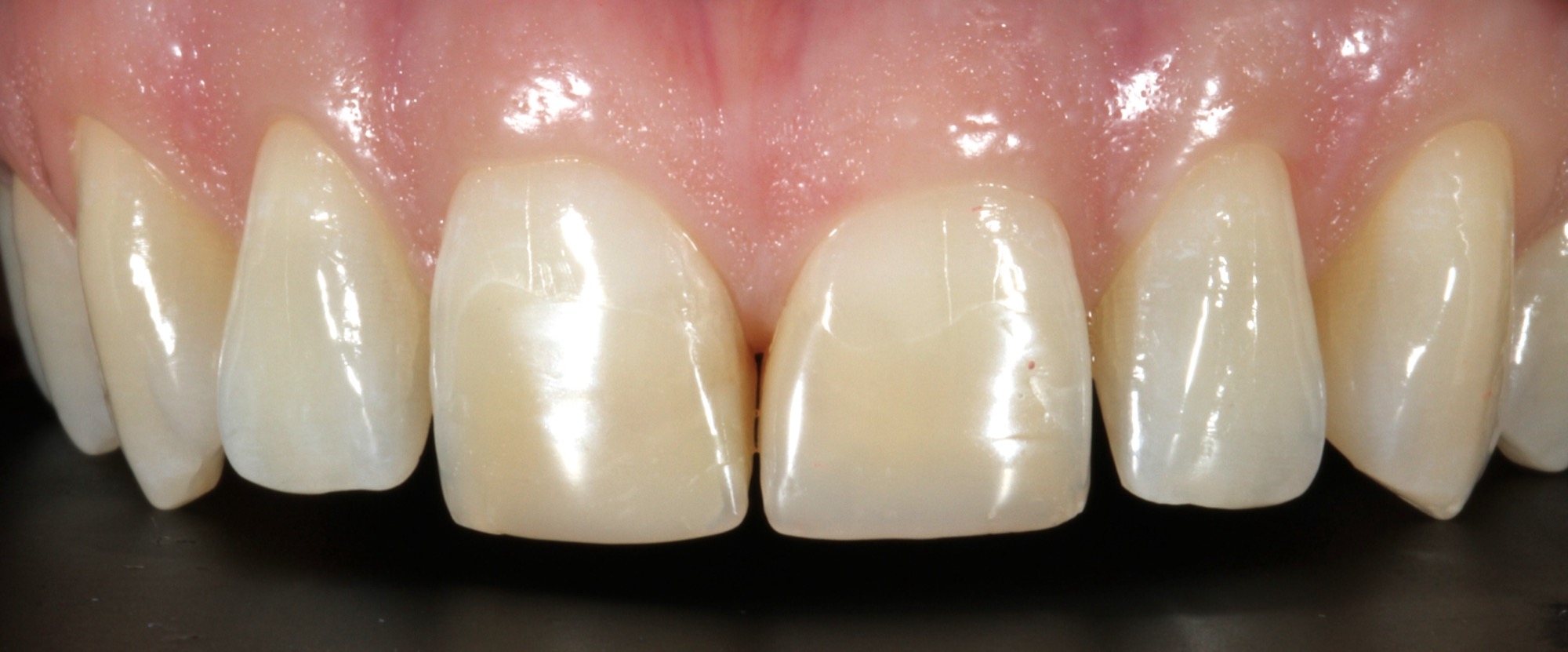 Before treatment
